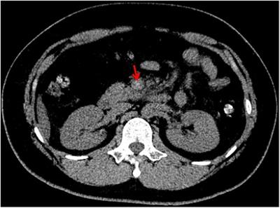 Case Report: First attempt by off-label use of tenecteplase to treat acute extensive portal venous system thrombosis